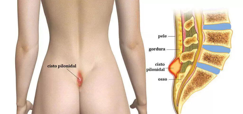 Cisto Pilonidal: Quando a Cirurgia É Indicada?